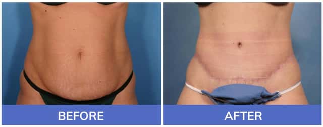 Tummy Tuck Before-and-After