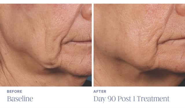 Ellacore before and after 90 days photo