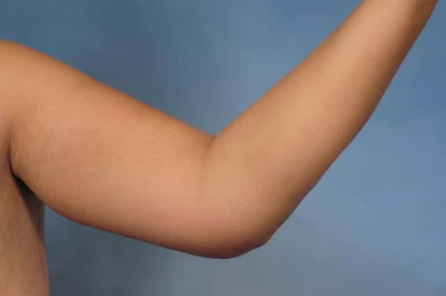 Arm Lift Before & After Case 132 after