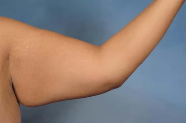 Arm Lift Before & After Case 132 before