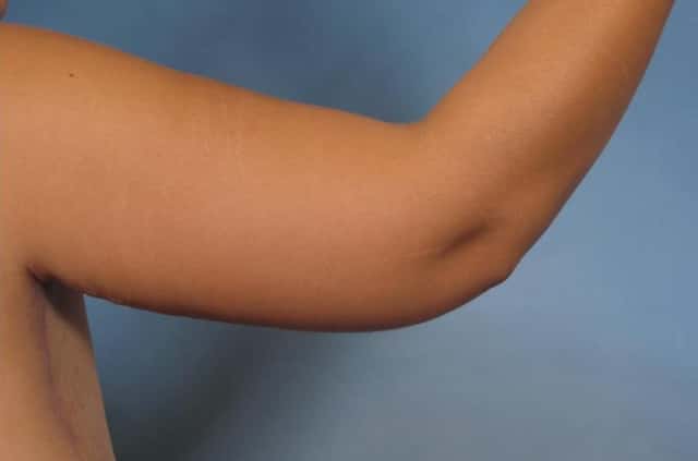 Arm Lift Before & After Case 132 after