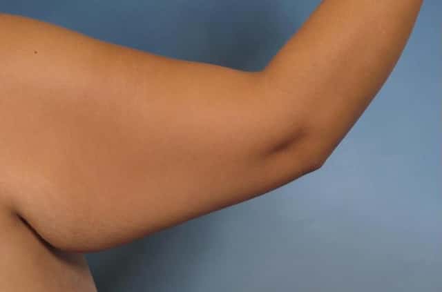 Arm Lift Before & After Case 132 before