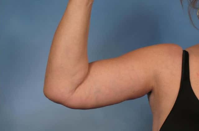 Arm Lift Before & After Case 133 after