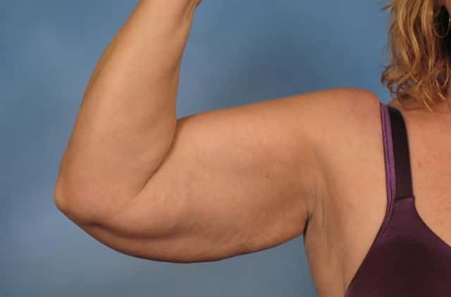 Arm Lift Before & After Case 133 before