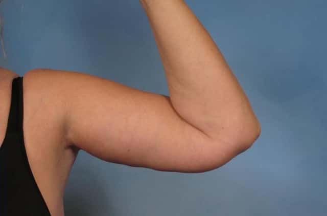 Arm Lift Before & After Case 133 after