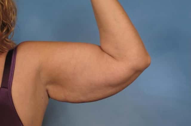 Arm Lift Before & After Case 133 before