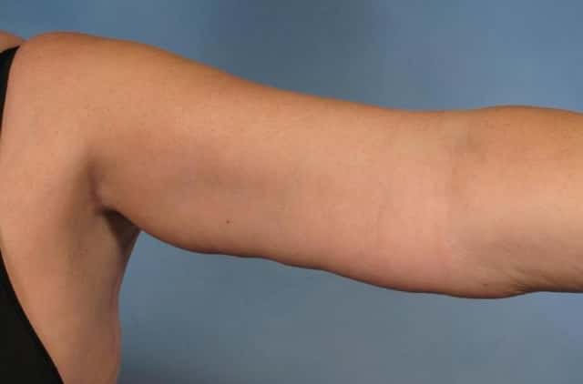 Arm Lift Before & After Case 133 after