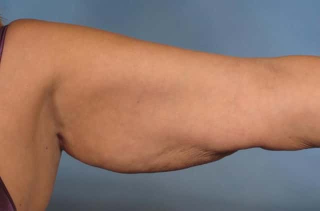 Arm Lift Before & After Case 133 before