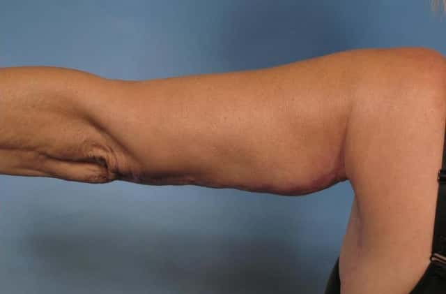 Arm Lift Before & After Case 133 after