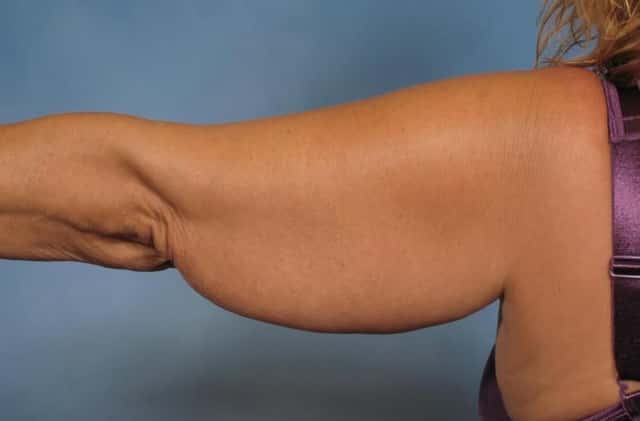 Arm Lift Before & After Case 133 before