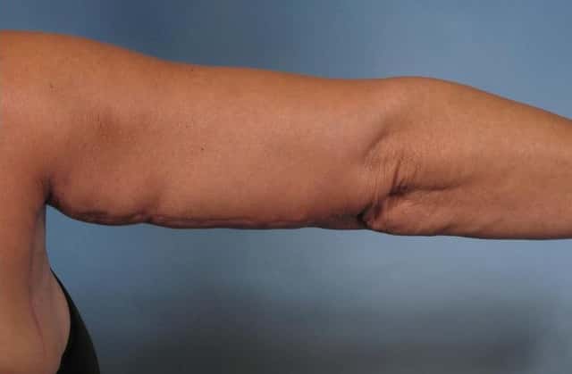 Arm Lift Before & After Case 133 after