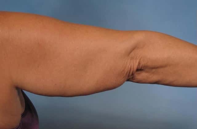 Arm Lift Before & After Case 133 before