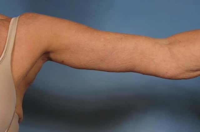 Arm Lift Before & After Case 174 after