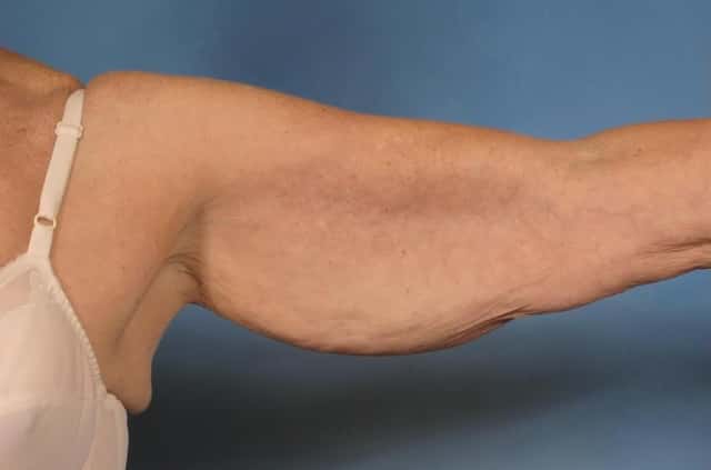 Arm Lift Before & After Case 174 before
