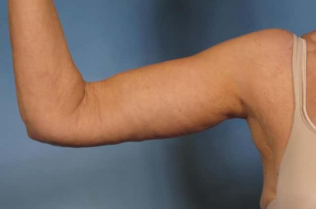 Arm Lift Before & After Case 174 after