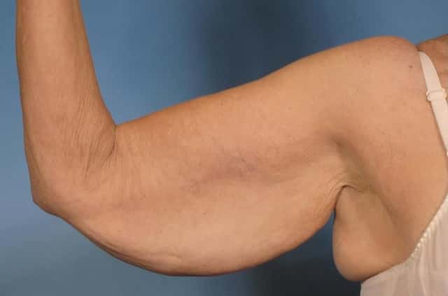 Arm Lift Before & After Case 174 before