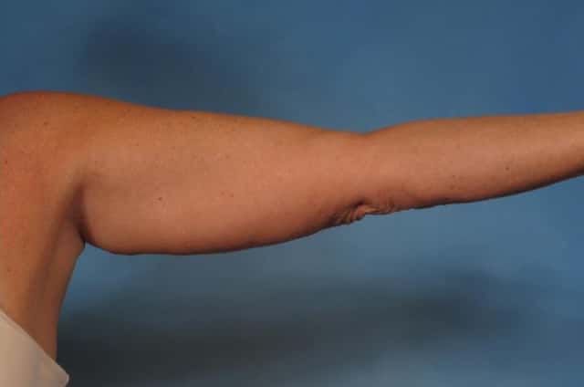 Arm Lift Before & After Case 193 after