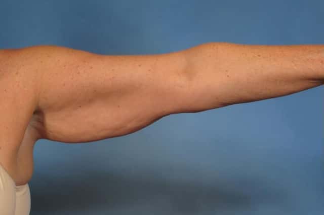Arm Lift Before & After Case 193 before