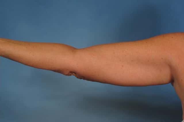 Arm Lift Before & After Case 193 after