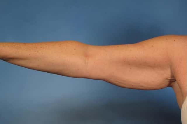 Arm Lift Before & After Case 193 before