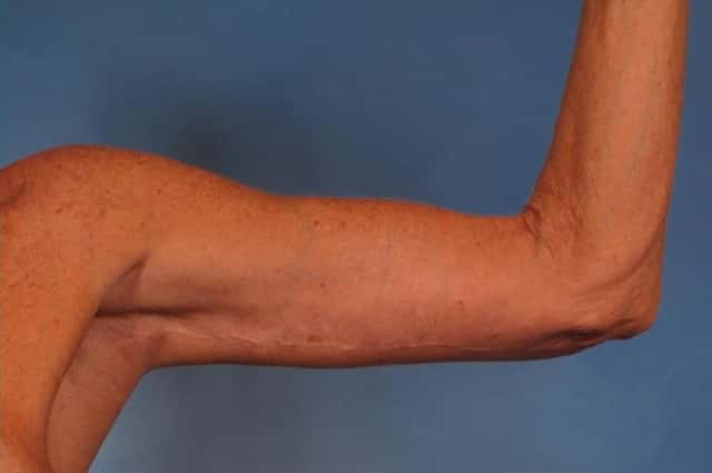 Arm Lift Before & After Case 246 after