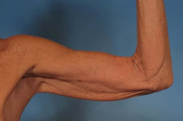 Arm Lift Before & After Case 246 before