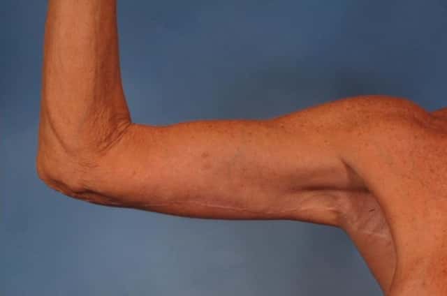 Arm Lift Before & After Case 246 after