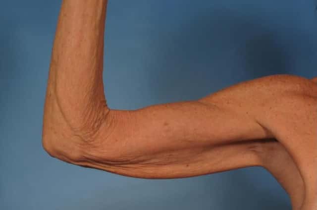 Arm Lift Before & After Case 246 before
