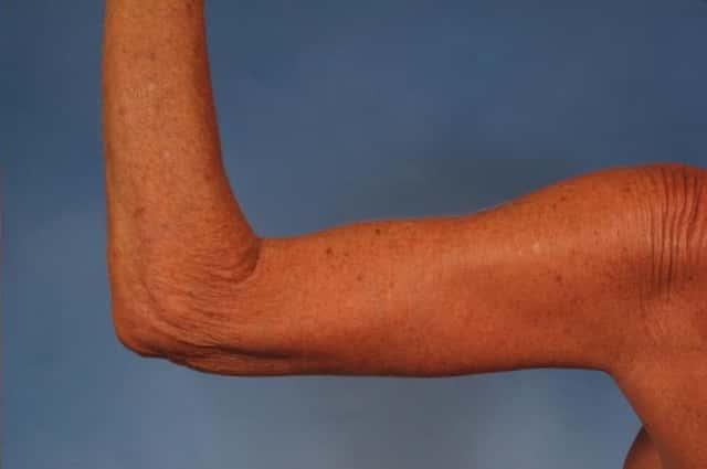 Arm Lift Before & After Case 246 after