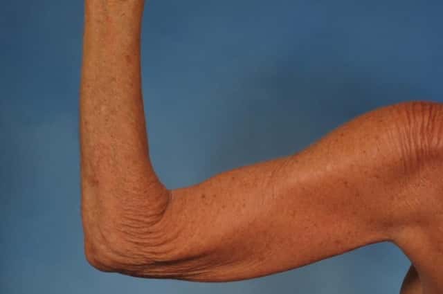 Arm Lift Before & After Case 246 before