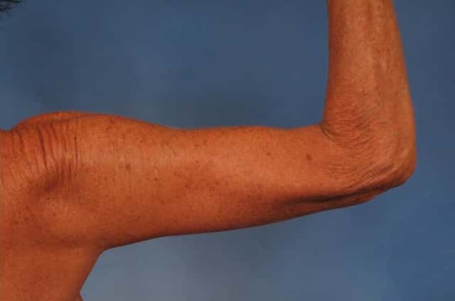 Arm Lift Before & After Case 246 after