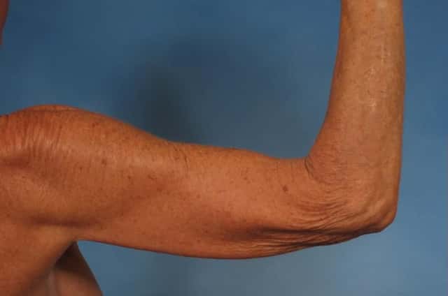 Arm Lift Before & After Case 246 before