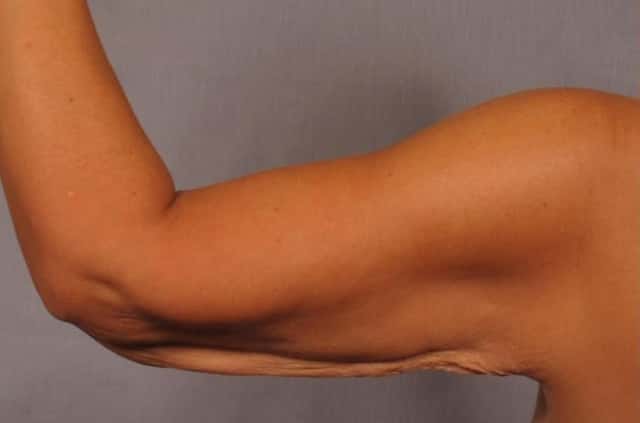 Arm Lift Before and 6 Months After, Left Back Bent