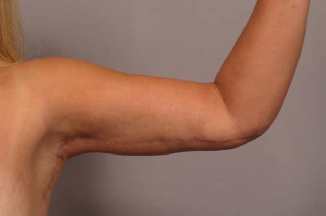 Arm Lift Before and 6 Months After, L Inner Bent