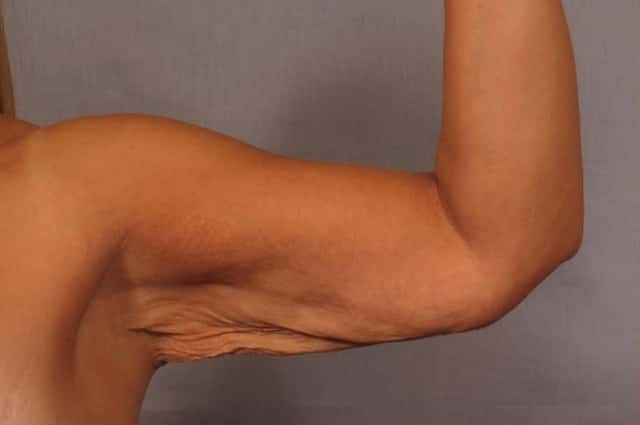 Arm Lift Before and 6 Months After, Left Inner Bent