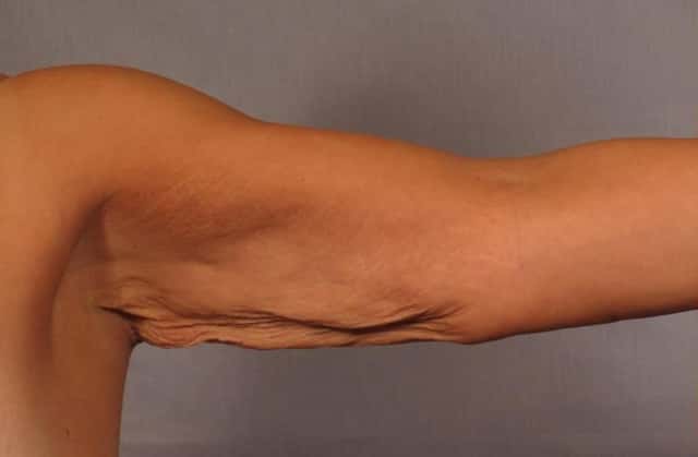 Arm Lift Before and 6 Months After, Left Inner Straight