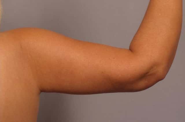 Arm Lift Before and 6 Months After, Right Back Bent