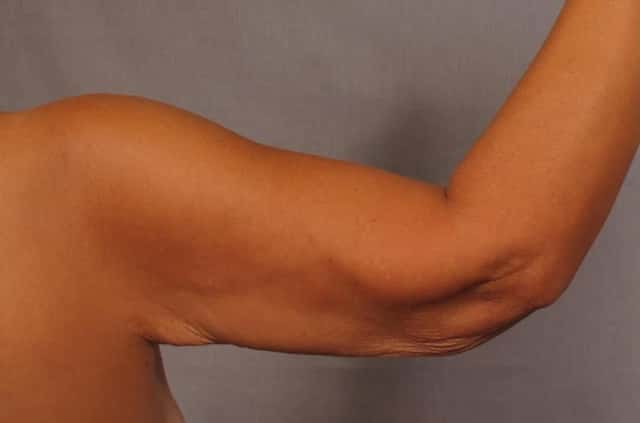 Arm Lift Before and 6 Months After, Right Back Bent