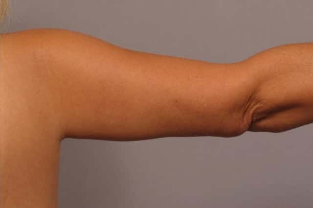 Arm Lift Before and 6 Months After, Right Back Straight