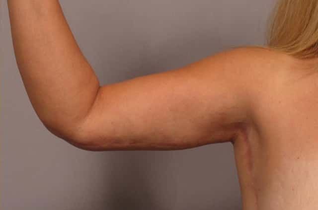 Arm Lift Before and 6 Months After, R Inner Bent
