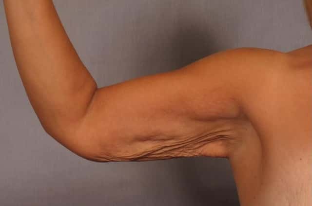 Arm Lift Before and 6 Months After, Right Inner Bent
