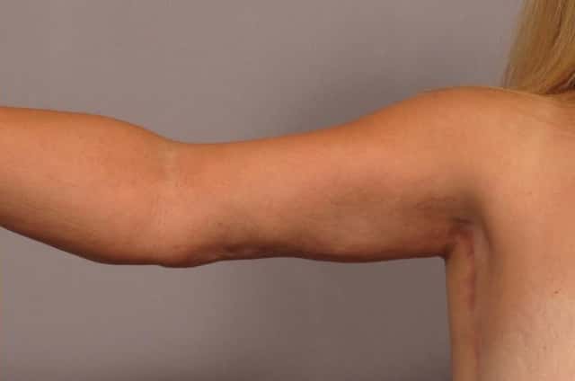 Arm Lift Before and 6 Months After, R Inner Strt