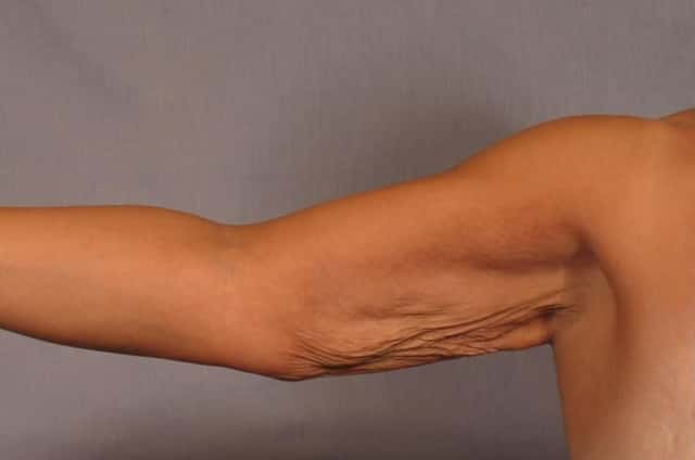 Arm Lift Before and 6 Months After, Right Inner Straight