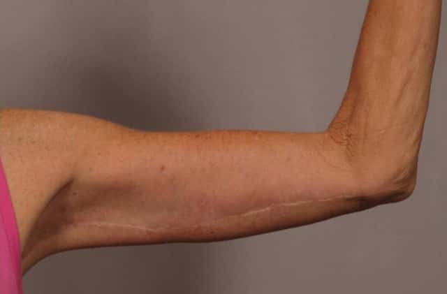 Inside View of Left Upper Arm 6 Months After Arm Lift (Brachioplasty)