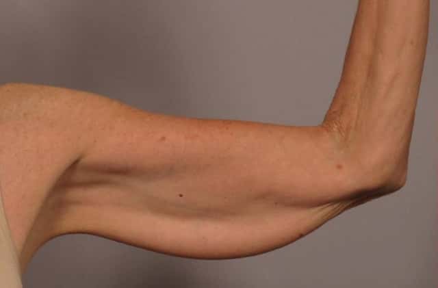Inside View of Left Upper Arm Before Arm Lift (Brachioplasty)