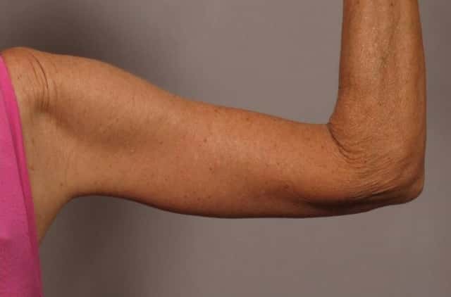 Posterior View of Right Upper Arm 6 Months After Arm Lift (Brachioplasty)
