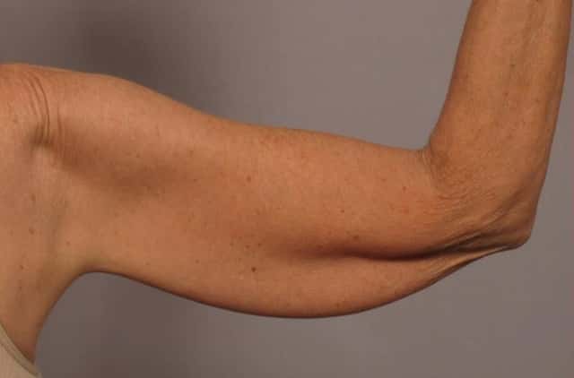 Posterior View of Right Upper Arm Before Arm Lift (Brachioplasty)