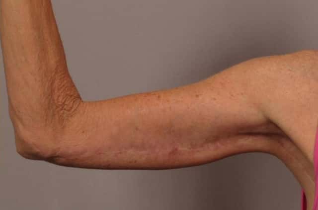 Inside View of Right Upper Arm 6 Months After Arm Lift (Brachioplasty)