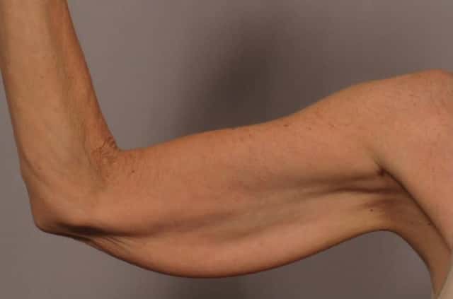 Inside View of Right Upper Arm Before Arm Lift (Brachioplasty)