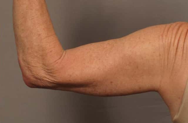 Posterior View of Left Upper Arm 1 Year After Arm Lift (Brachioplasty)
